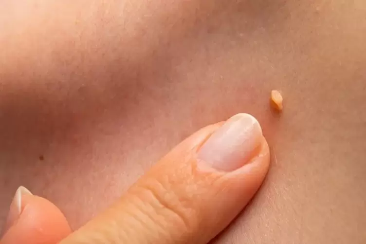 Papilomas en la piel