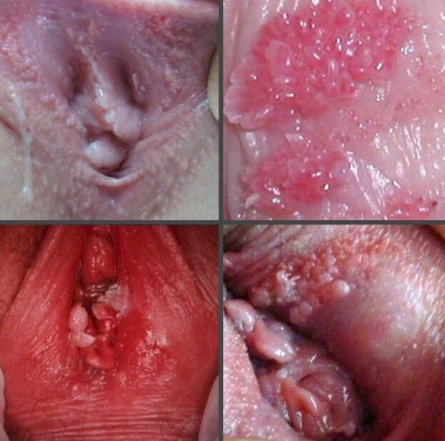Papiloma cerrado en la vagina