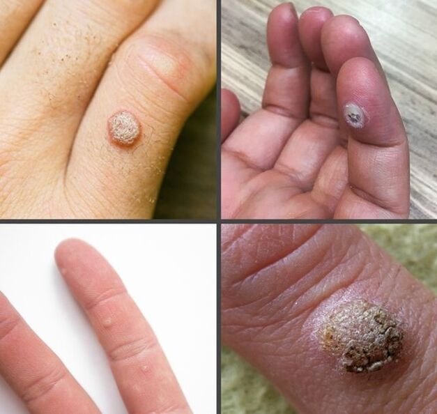 Un tipo común de verruga en el dedo